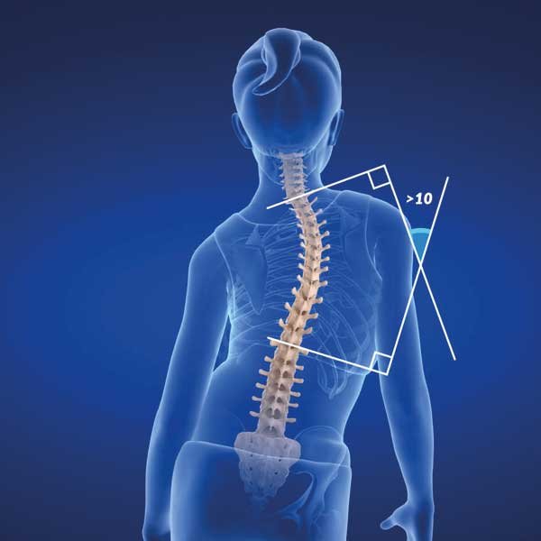 idiopathic-scoliosis