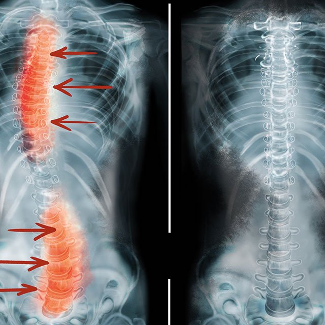 scoliosis-curvature-of-the-spine