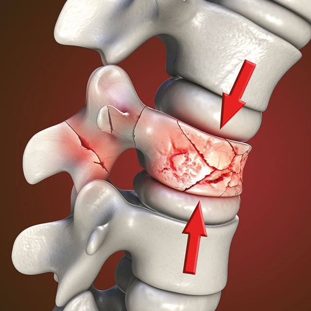 spinal-fractures