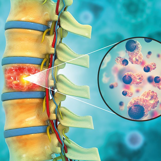 spine-tumors